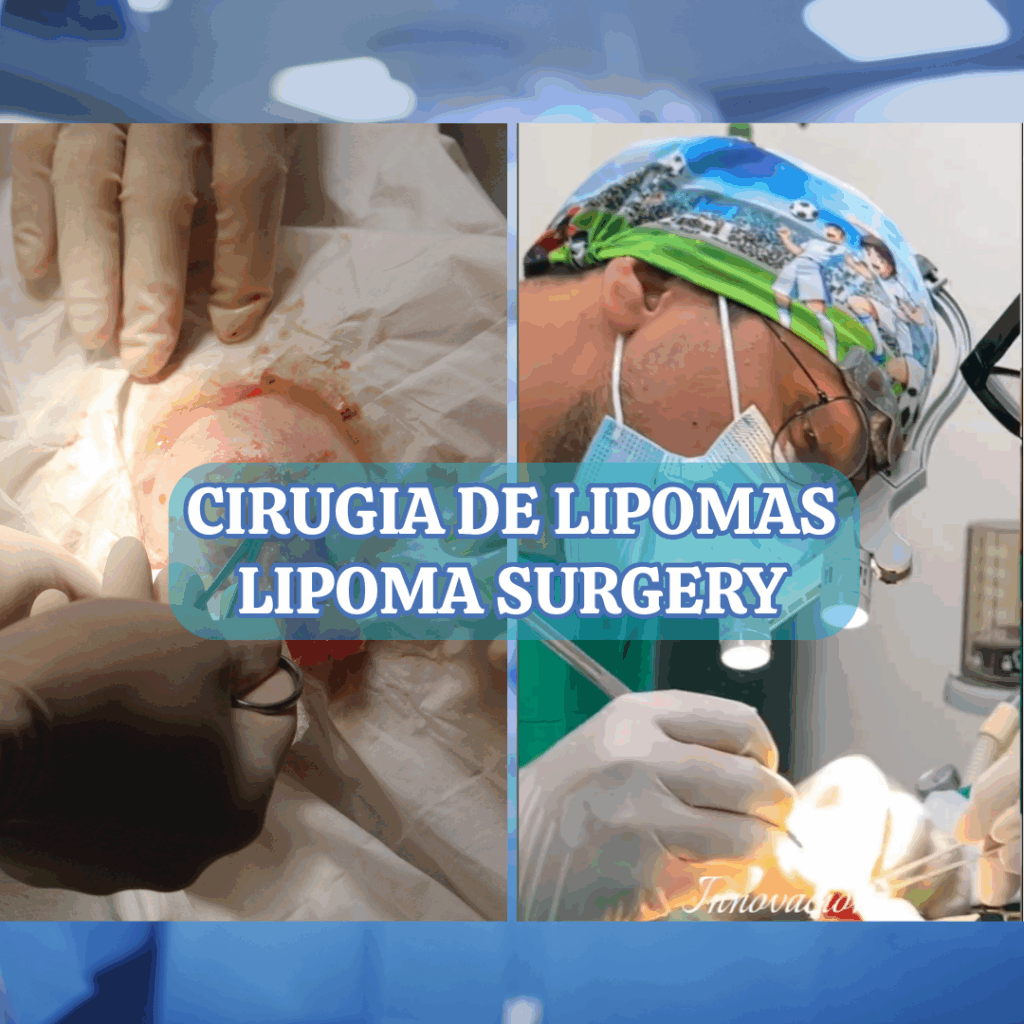 CIRUGIA_LIPOMAS