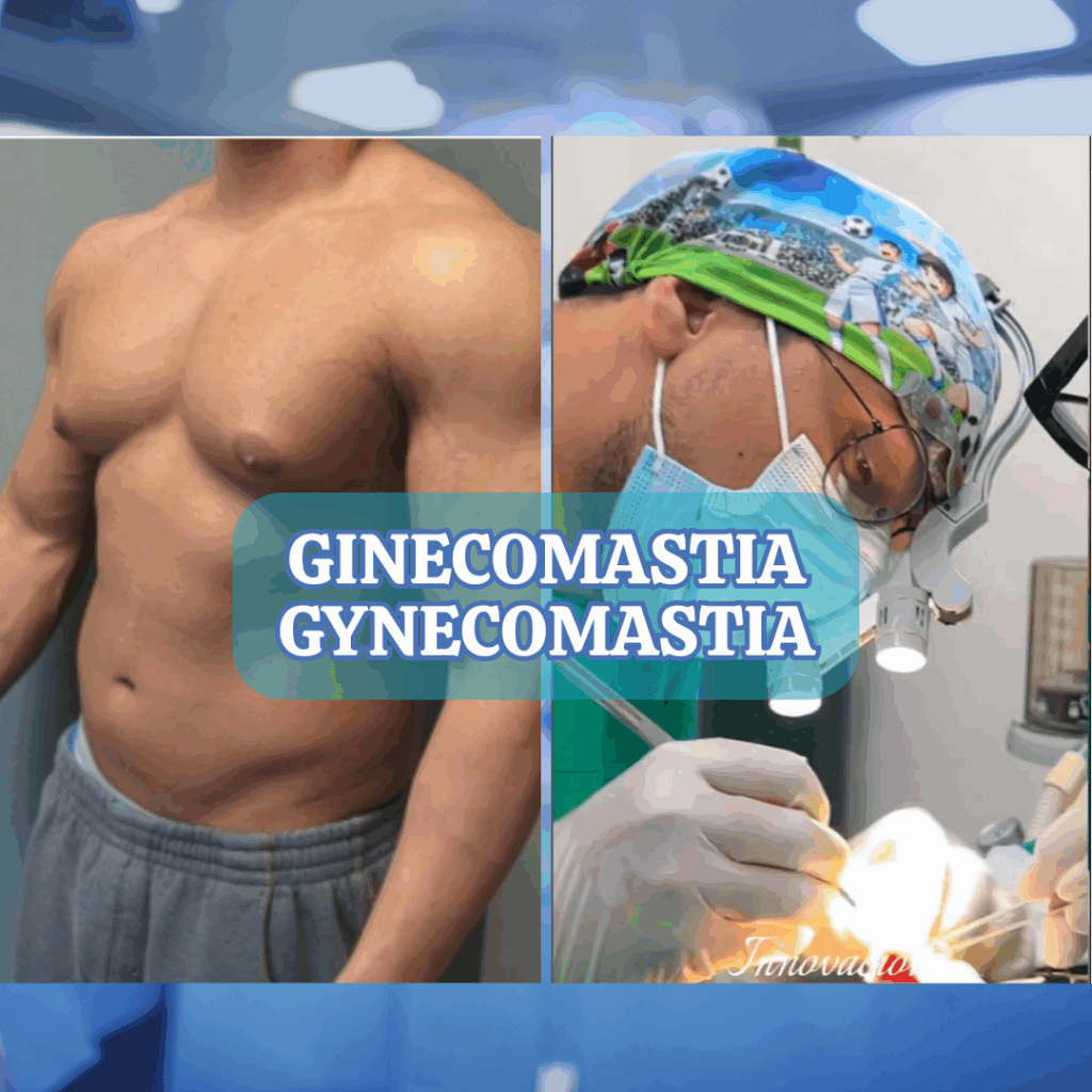 GINECOMASTIA
