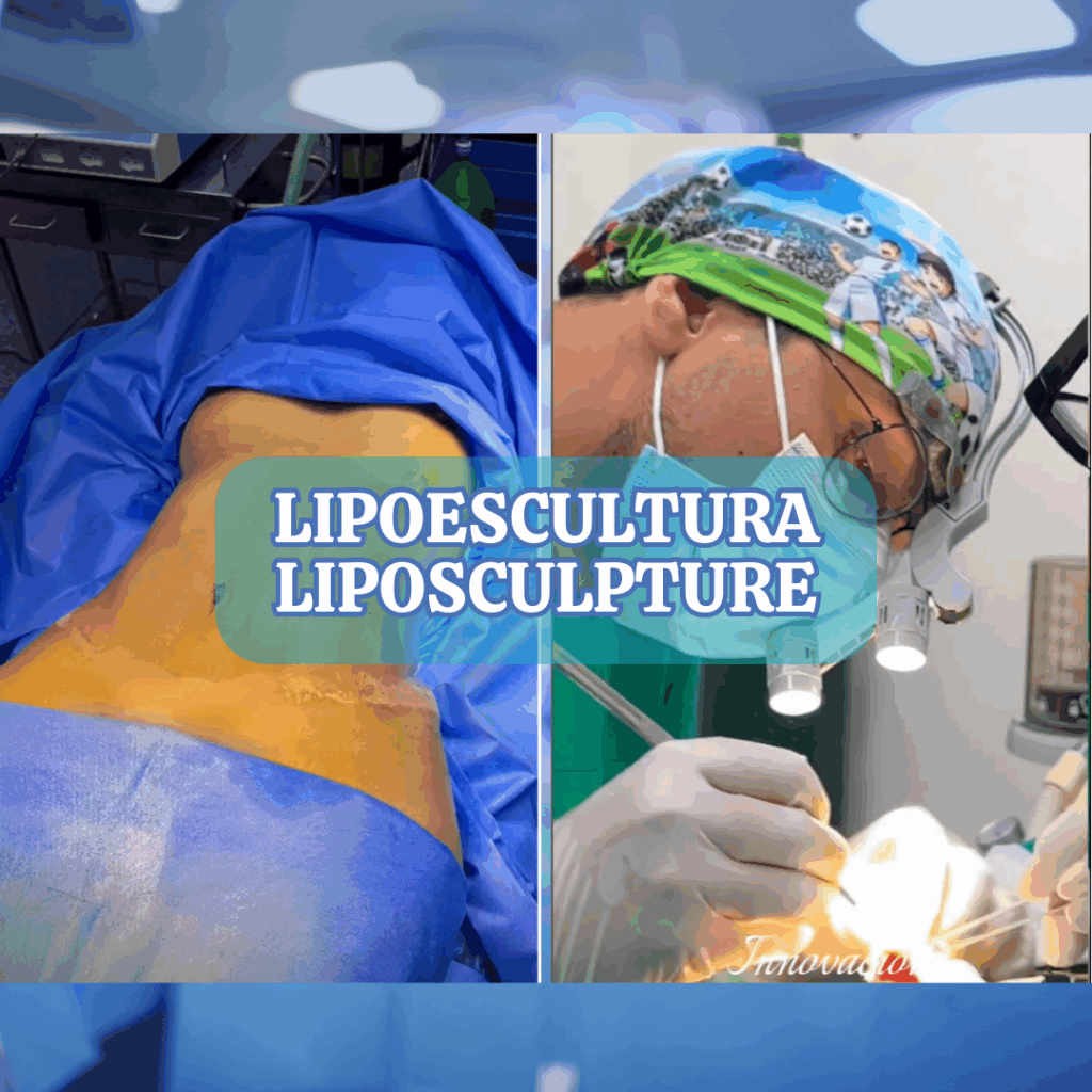 LIPOESCULTURA